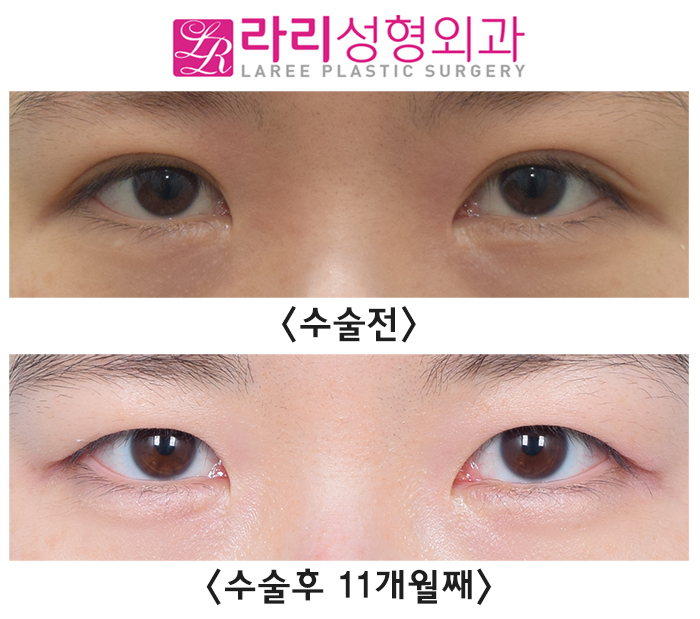 [라리성형외과] 지겨운 소세지 쌍꺼풀 싫어요, 자연스러운 속쌍 쌍꺼풀재수술 관련 이미지 1