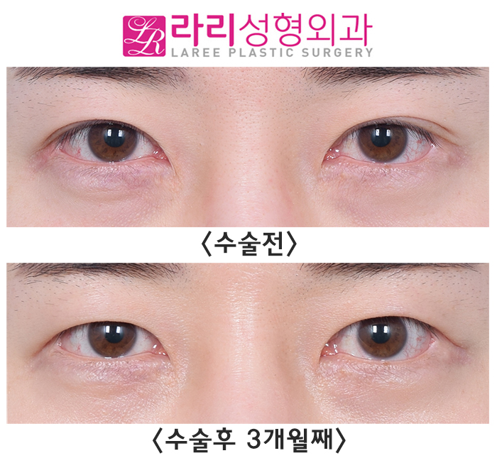 [Lari Plastic Surgery] Surgery to Remove Double Eyelids: Can It Really Make Double Eyelids Disappear? "YES!" image 1