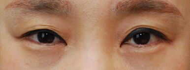 Revision Eyelid Surgery, Cases That Need Ptosis Correction, Correcting Asymmetry in Uneven Eyes image 1