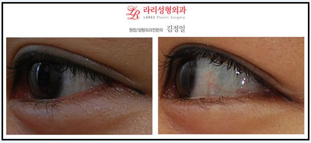 뒤트임/뒷트임 사진 후기 정보☆ 관련 이미지 4