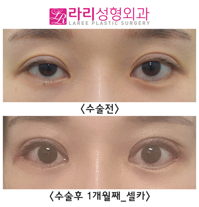 [라리성형외과] 쌍꺼풀재수술, 밑트임복원, 뒤트임재수술 후 다시 태어난 눈 리얼 셀카 후기 관련 이미지 1