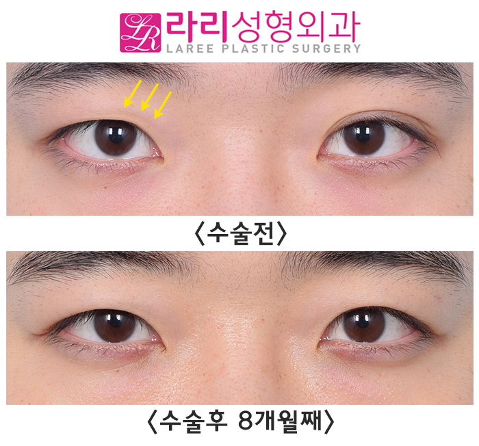 [라리성형외과]  한쪽만 진한 자연쌍꺼풀, 쌍꺼풀없애기 양쪽 다 수술한 전후사진 관련 이미지 5