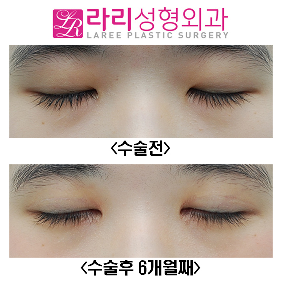 [Lari Plastic Surgery] Before-and-After Photos Showing Clear Results from Incisional Eye Correction and Epicanthoplasty image 4