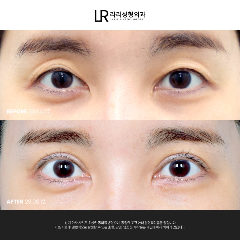 [라리성형외과] 여러 모양의 앞트임 흉터가 고민이라면 관련 이미지 4