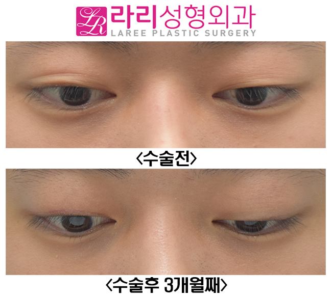 [라리성형외과] 한쪽 쌍수? 한쪽쌍꺼풀없애기? 반대쪽에 쌍꺼풀이 생겨요 관련 이미지 3