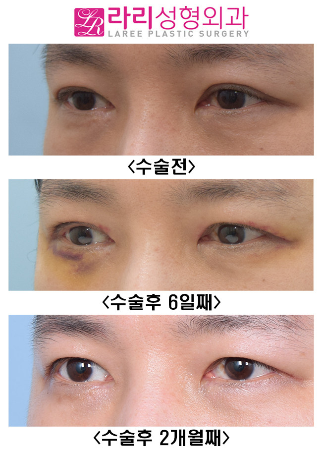 [라리성형외과] 쌍꺼풀없애기 수술 후 짝짝이, 괜찮아질까? 관련 이미지 6