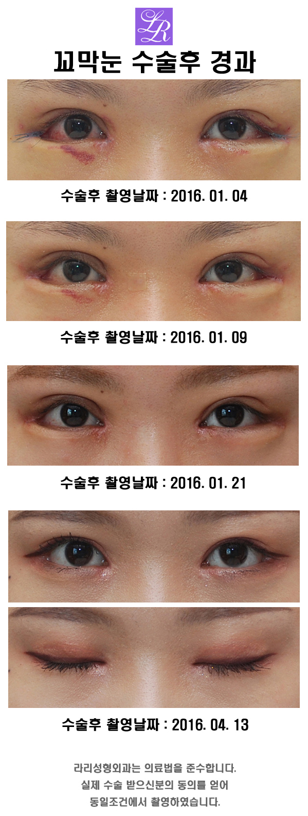 꼬막눈 쌍수 - 짧은눈 왕눈이 수술 관련 이미지 3