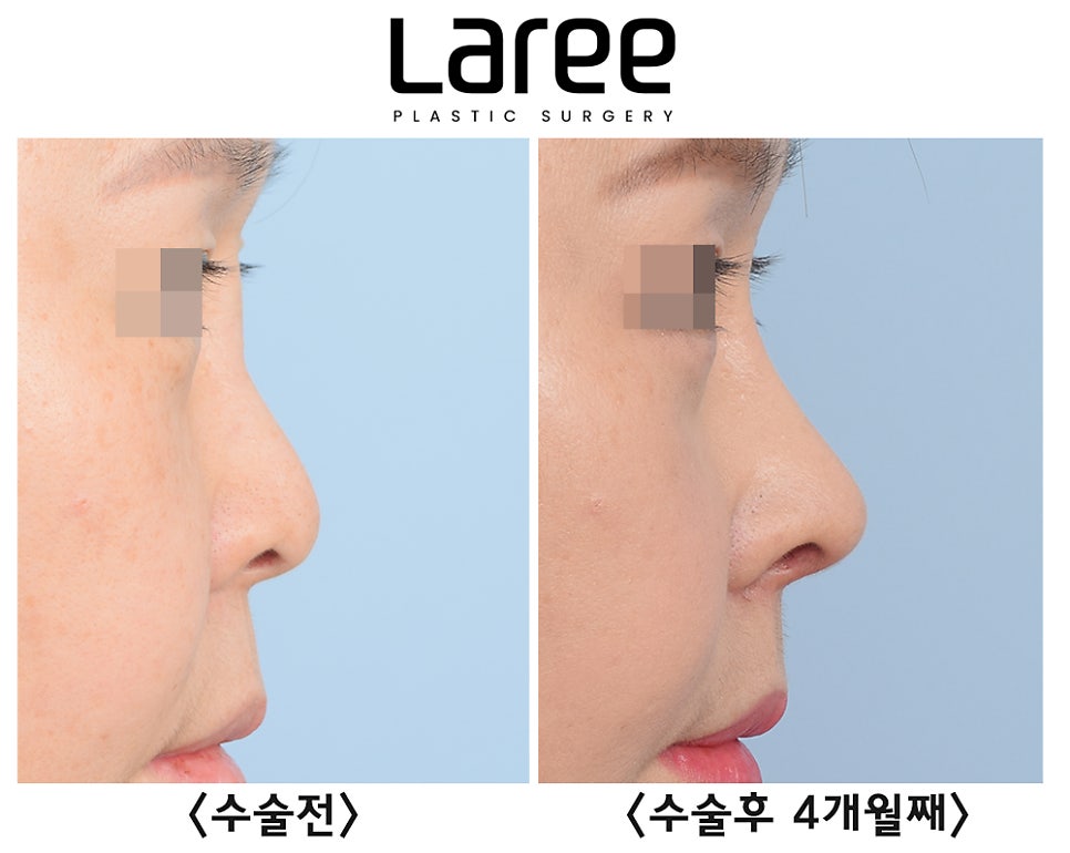 [라리성형외과] 고양이수술과 인중축소수술을 병행한 자가늑 코재수술(+콧대영구필러제거) 관련 이미지 4