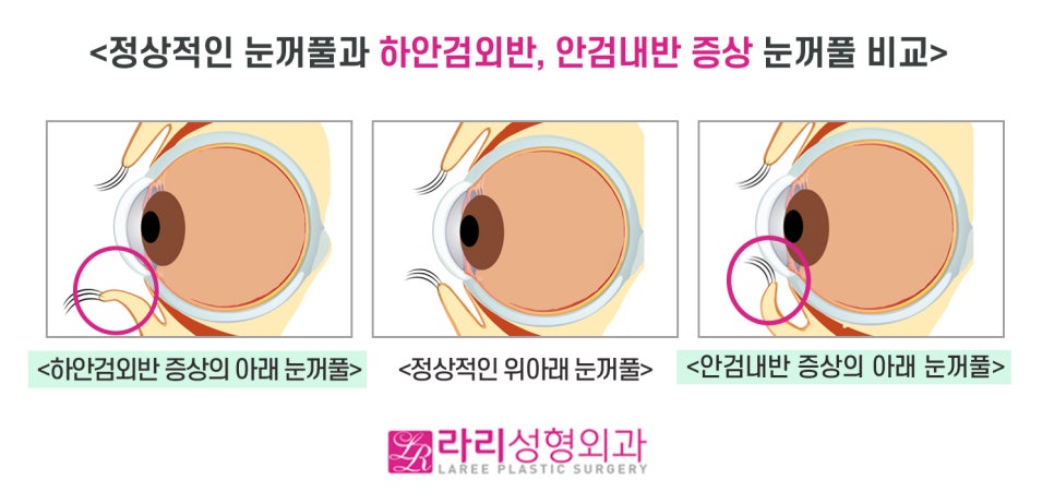 [라리성형외과] 안검내반과 안검외반, 무엇이 다를까 ? 관련 이미지 1