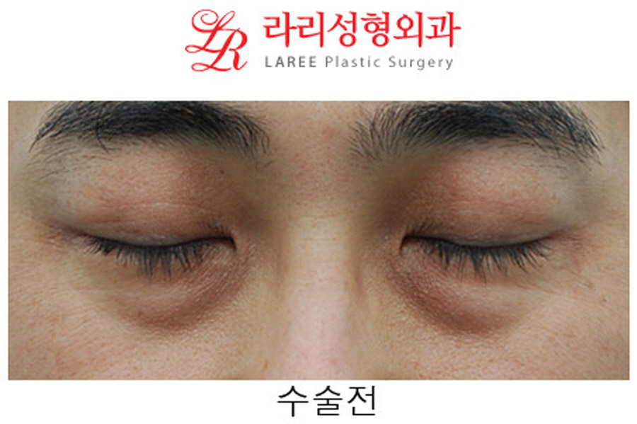 Under-Eye Fat Repositioning Before and After in Your 40s image 3