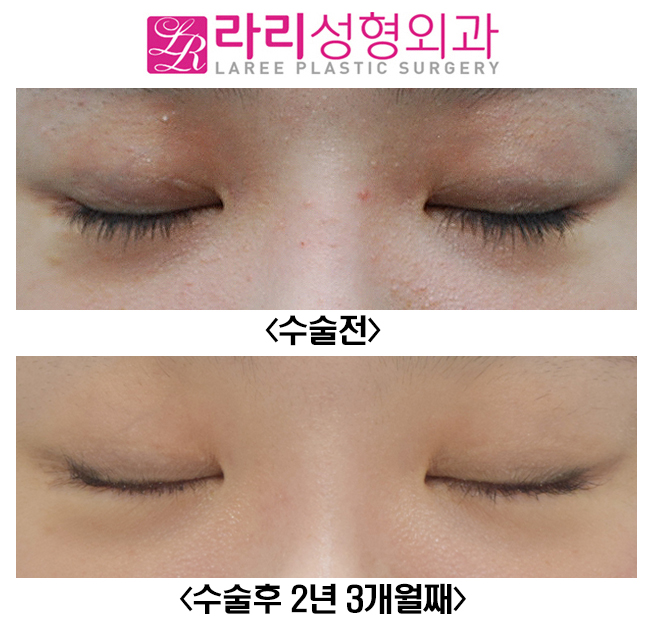 [라리성형외과] 최소한의 뒤트임 복원수술로 최대한의 효과를(+쌍수 짝짝이 교정) 관련 이미지 5