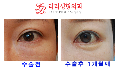 Revision Double Eyelid Surgery (Sausage Correction), Epicanthoplasty, Canthoplasty, Under-Eye Fat Removal, and Aegyo-Sal Fat Grafting image 3