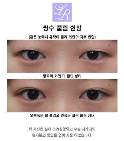 Double eyelid surgery with an inner crease as charming as an outer crease image 3