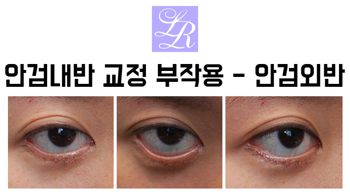 속눈썹 찌름 - 안검내반 교정 최소절개 흉터에 대해 관련 이미지 9