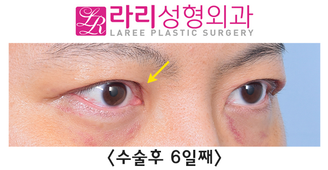 [Rari Plastic Surgery] Recovery Process for Line Irregularity During the Course of Double Eyelid Removal Surgery image 5