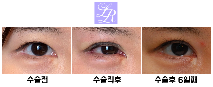Revision Surgery to Raise the Buried Double Eyelid Line - Will It Change the Eye Shape? image 1