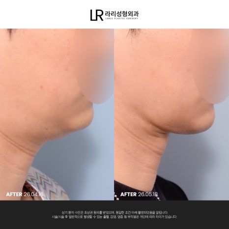 [라리성형외과] 이중턱 지방 흡입만으로는 아쉬운 얼굴 라인, 이중턱 근육 묶기도 같이 하면 효과가 두 배! 관련 이미지 13
