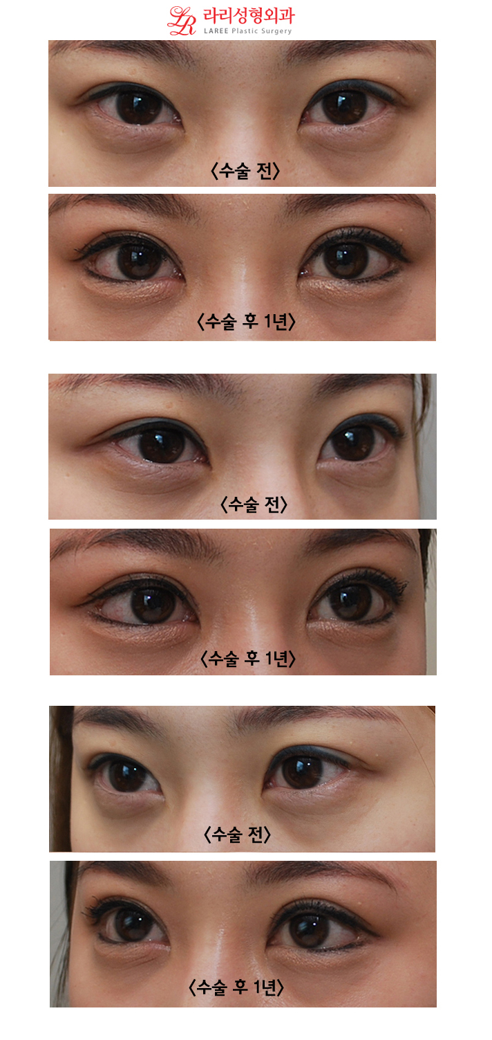 눈꼬리내리기뒤트임과 윗트임의 장기경과 전후사진 관련 이미지 1