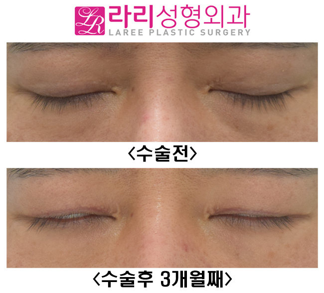 [Lari Plastic Surgery] Surgery to remove double eyelids only removes the double eyelids. image 3