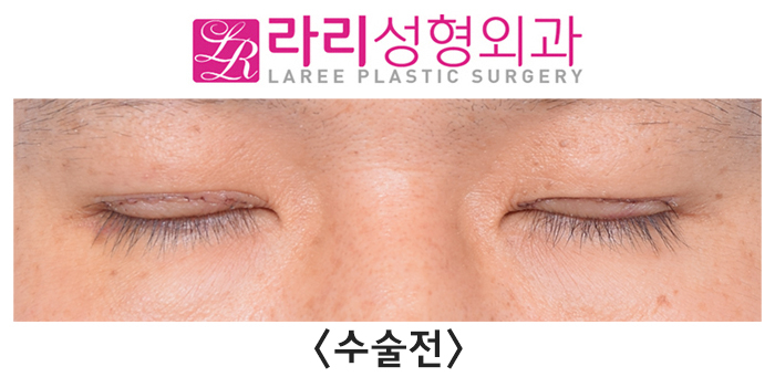 [라리성형외과] 절개 눈매교정 후 급속교정, 6개월 기다리지 않고 일주일 만에 쌍꺼풀없애기 관련 이미지 2