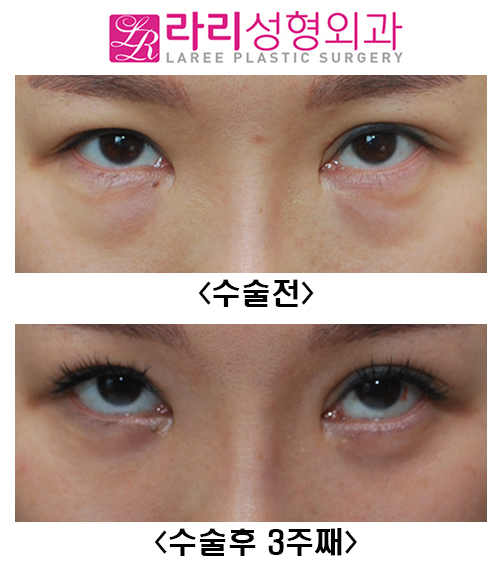 [라리성형외과] 눈밑지방재배치 수술후 3주째 경과 관련 이미지 2
