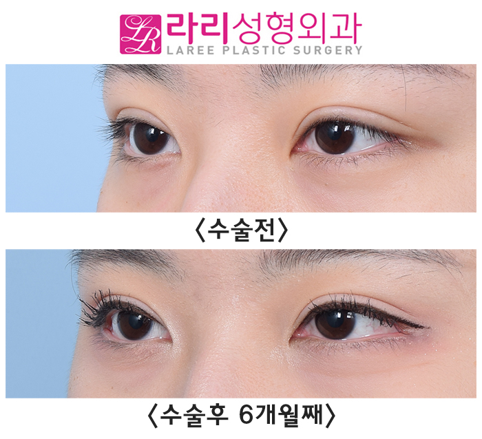 [라리성형외과] 6개월 차 자연스럽지만 티나는 눈꼬리내리기뒤트임 수술 전후 사진 관련 이미지 3