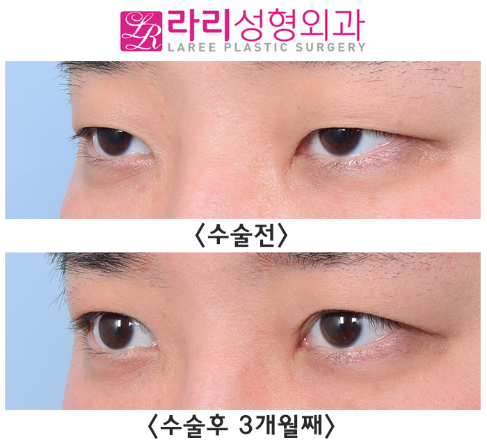 [Lari Plastic Surgery] Before and After Incisional Ptosis Correction Surgery for a Soft Impression Without Feeling Overdone image 3