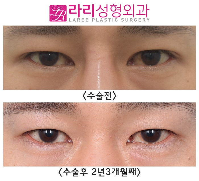 [Rari Plastic Surgery] Removing Double Eyelids Completely / No Double Eyelids When Eyes Are Open, No Double Eyelids When Eyes Are Closed image 1