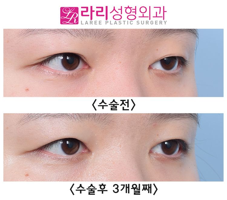 [라리성형외과] 쌍꺼풀없애는수술에 대하여 관련 이미지 3