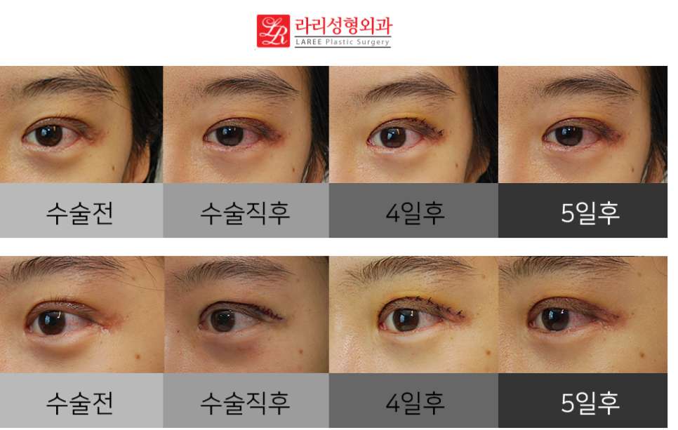 Correcting Double Eyelid Surgery Side Effects: Ectropion (feat. Rari Plastic Surgery) image 5