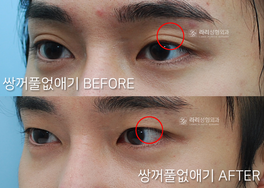 [라리성형외과] 쌍꺼풀없애기 무쌍수술, 자연스러운 변화와 눈 깜빡임을 확인하세요. 관련 이미지 1