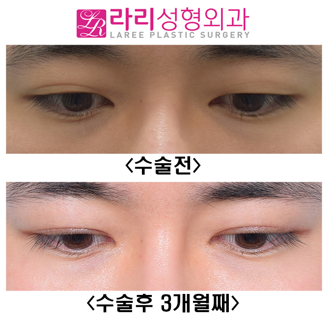 [Lari Plastic Surgery] Is it possible to have a distinct eye even with a hidden double eyelid?! (I don’t want uneven eyes) image 4