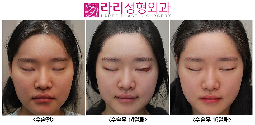 [Rari Plastic Surgery] About Conjunctival Edema After Canthoplasty.. (Causes and Management) image 2