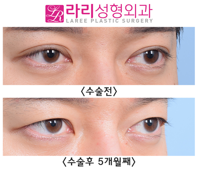 [라리성형외과] 완전 두꺼운 자연쌍꺼풀 무쌍 만들기 관련 이미지 4
