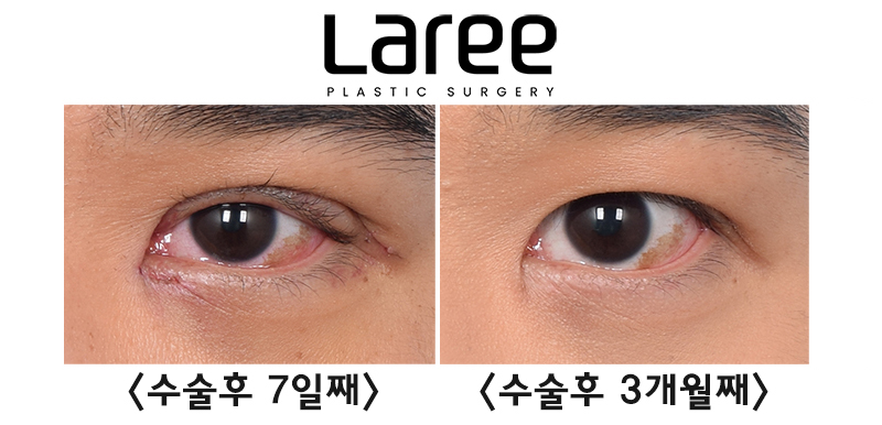[Lari Plastic Surgery] Eyelid Correction Surgery and Upper Canthoplasty: Experiencing the Maximum Effect of Non-Double-Eyelid Eyelid Correction Without Medial Drooping image 5