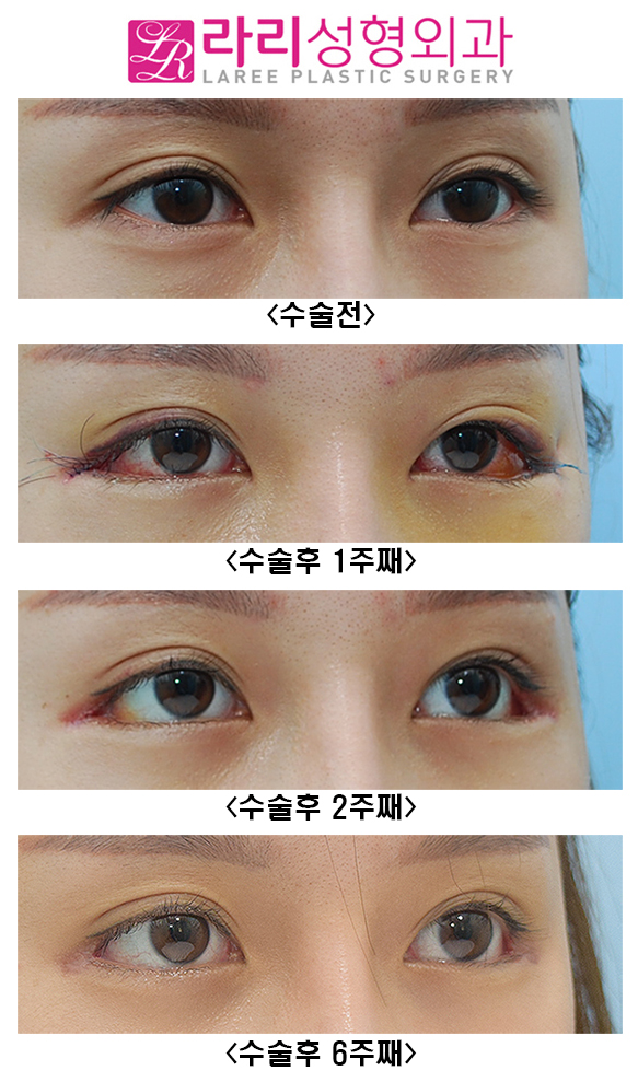 [Rari Plastic Surgery] Recovery Process of Non-Incisional Eye Correction Swelling image 2