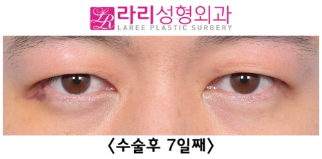 [라리성형외과] 쌍꺼풀없애기 수술 눈안감김(토안)의 원인이 정말 피부절제 때문일까? - 무절제쌍꺼풀없애기 관련 이미지 21