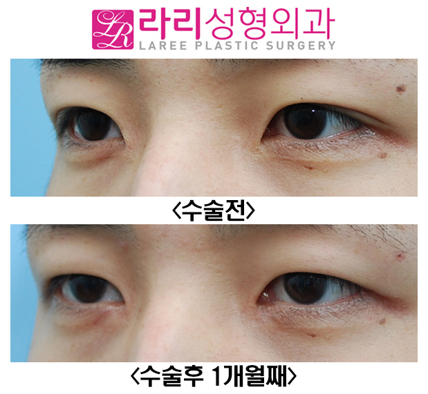 [Rari Plastic Surgery] Removing Double Eyelids Without a Crease and Medial Canthoplasty Are Effective for Changing the Look image 3