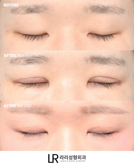 [Lari Plastic Surgery] Swelling After Double Eyelid Surgery: Why Does It Go Down Differently on Each Side? Will It Eventually Even Out? image 4