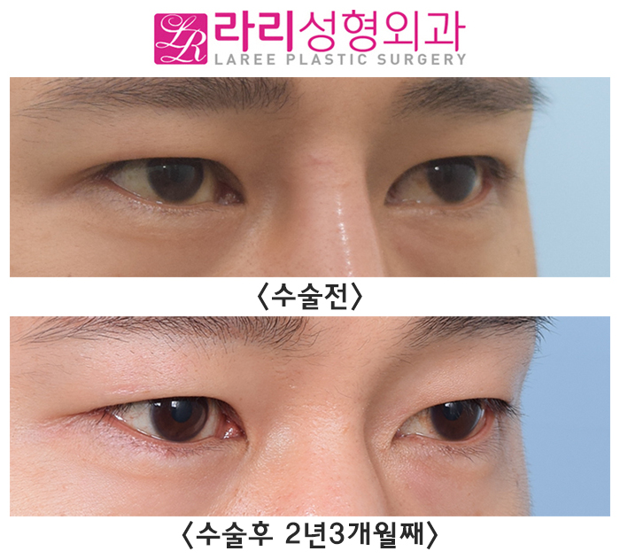 [Rari Plastic Surgery] Removing Double Eyelids Completely / No Double Eyelids When Eyes Are Open, No Double Eyelids When Eyes Are Closed image 2