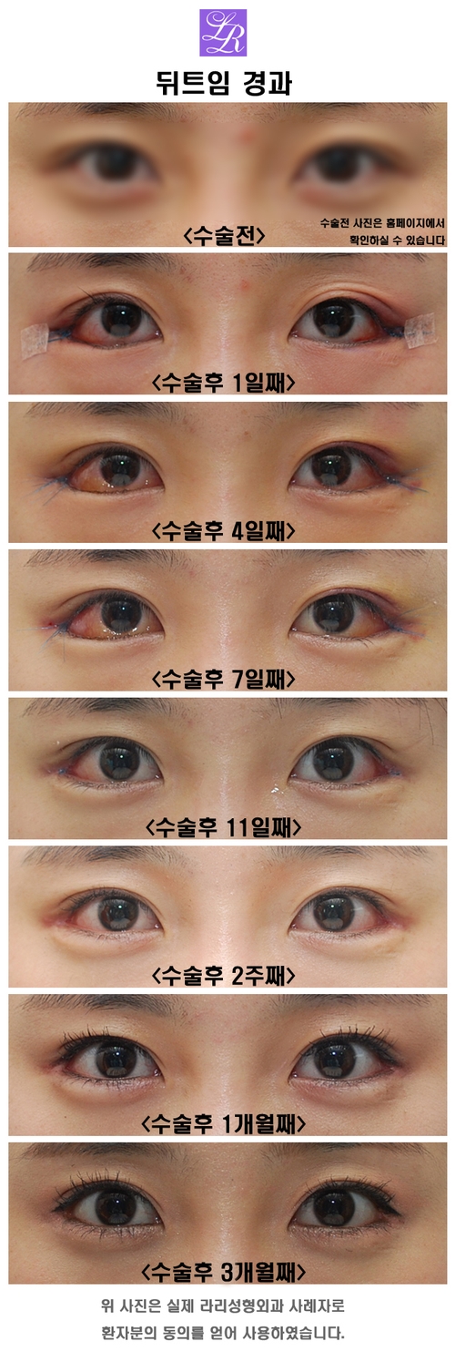 Revision Lateral Canthoplasty: Short-Term, Mid-Term, and Long-Term Progress (feat. Lari) image 1