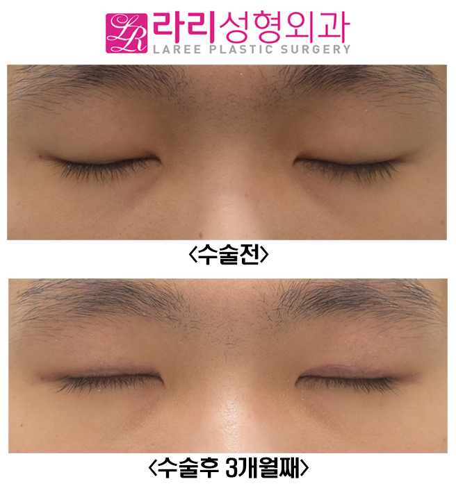 [라리성형외과] 남자 절개눈매교정 무쌍눈매교정 관련 이미지 3