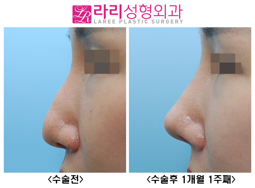 [Rari Plastic Surgery] Nose Bridge and Tip Surgery After Hyco Removal image 5