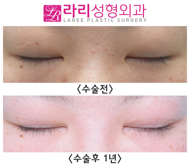 [라리성형외과] 절개눈매교정 자연스러운 인라인 속쌍 + 눈꺼풀 패인 흉터교정 관련 이미지 4