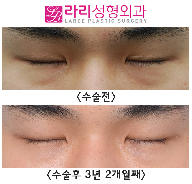 [라리성형외과] 절개 쌍꺼풀 부작용 풀림 현상 쌍꺼풀없애기 수술로 말끔하게 관련 이미지 5