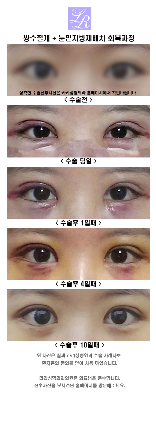 About Incision-Method Double Eyelid Surgery, Suture-Method Loosening, and Swelling image 3