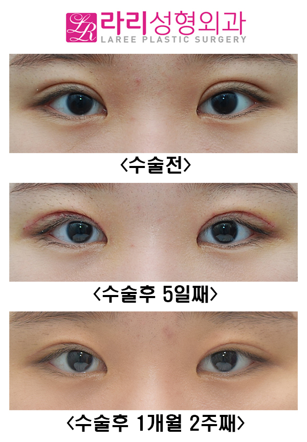 [Lari Plastic Surgery] Revision Double Eyelid Surgery and ROOF Fat Removal image 1
