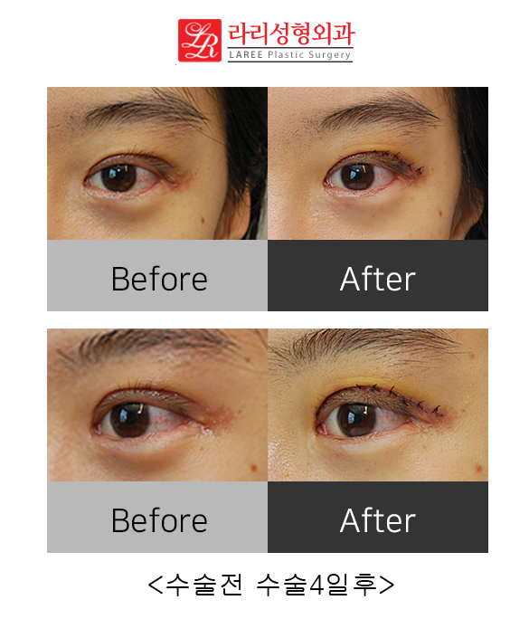 Correcting Double Eyelid Surgery Side Effects: Ectropion (feat. Rari Plastic Surgery) image 3