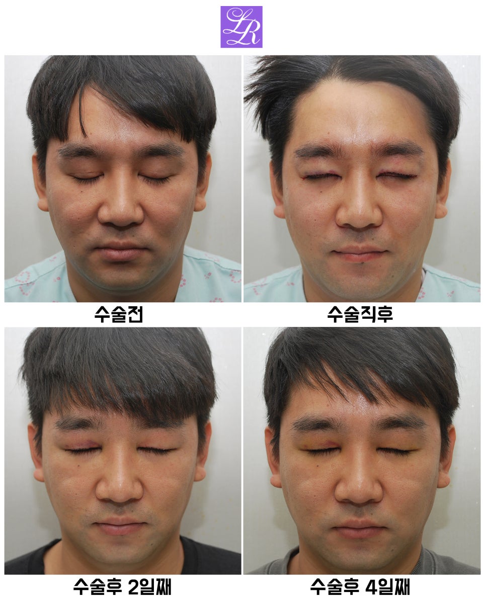 Review of Double Eyelid Reversal Surgery - Day 4 After Surgery, Swelling After Double Eyelid Surgery image 2