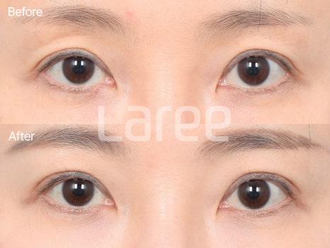 [Lari Plastic Surgery] Eyelid Fat Grafting for Improving the Eyelid Hollow: Incision Method vs. Non-Incision Method image 7